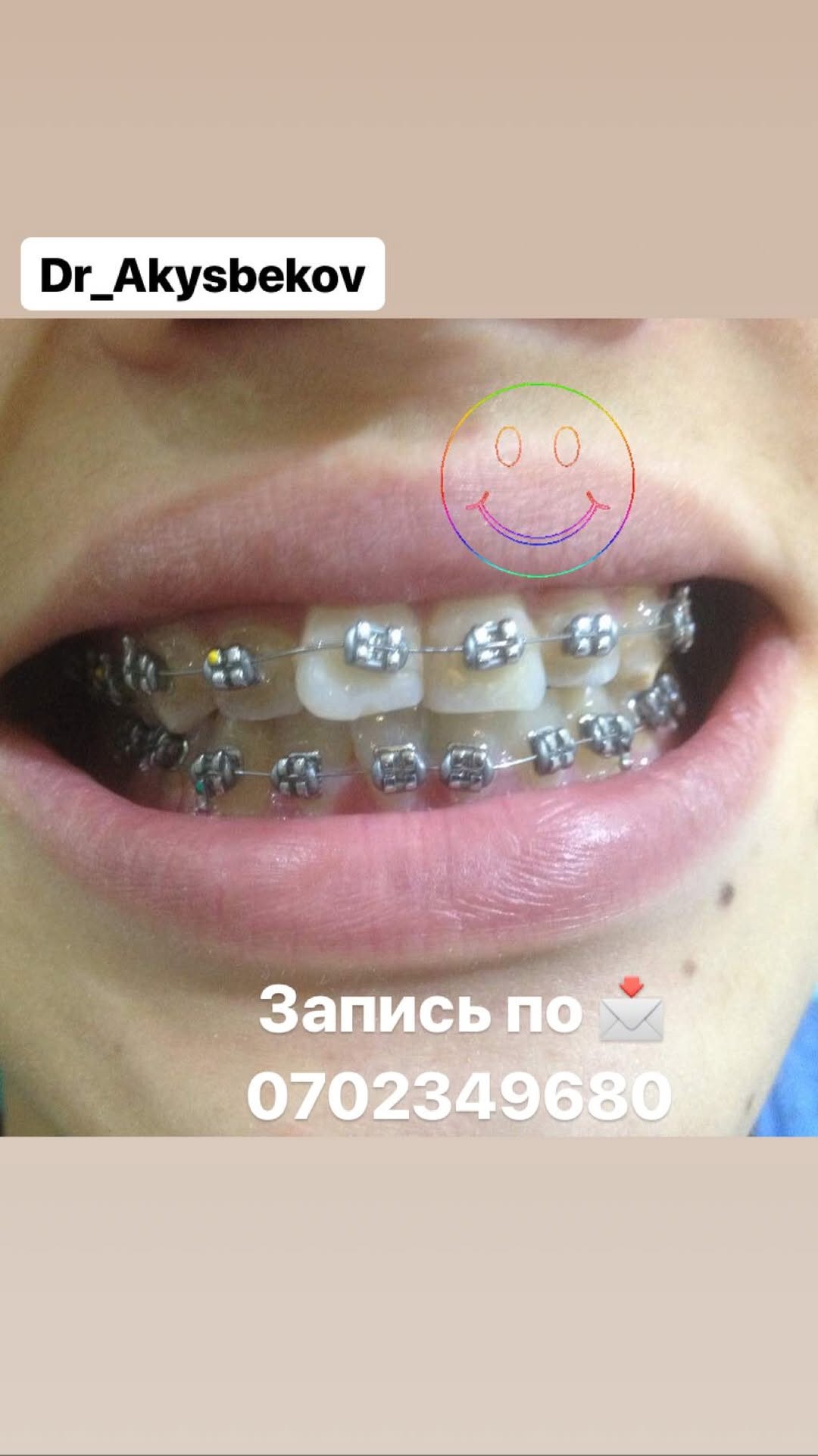 Каппы для исправления прикуса