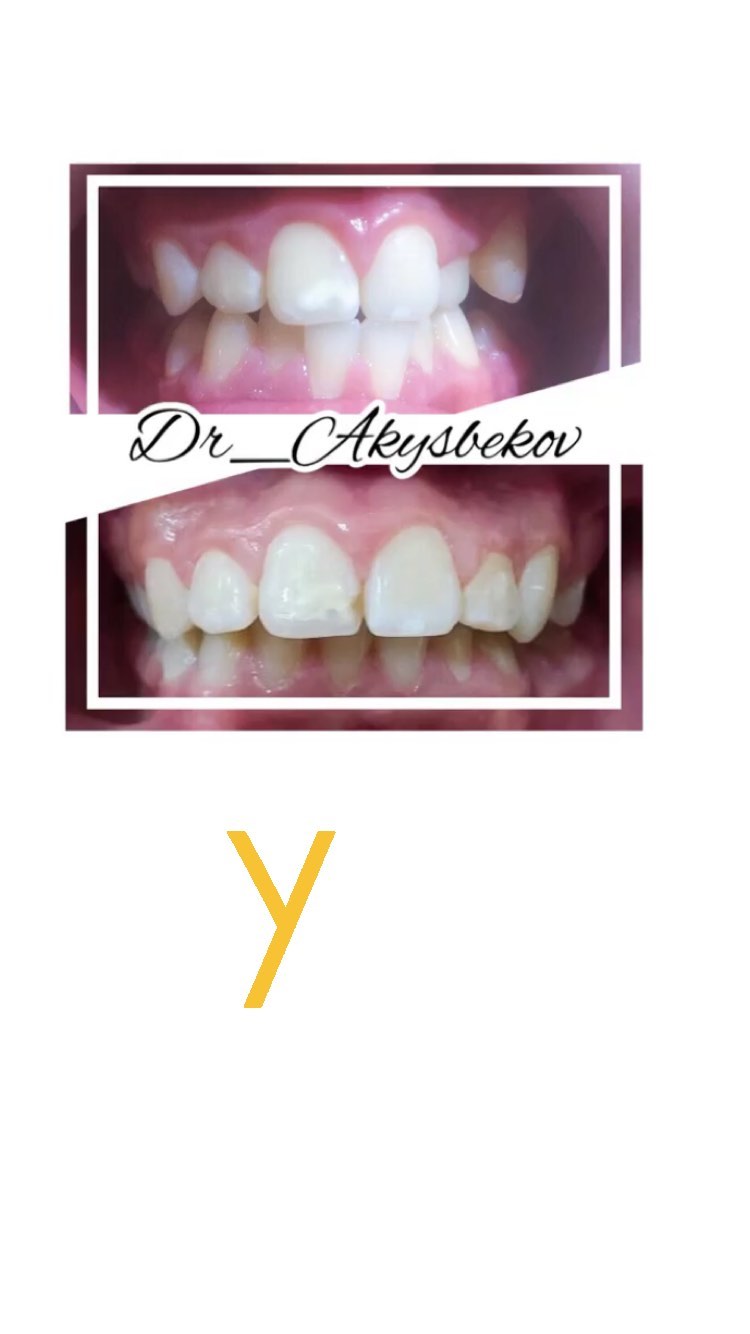 Чистка зубов