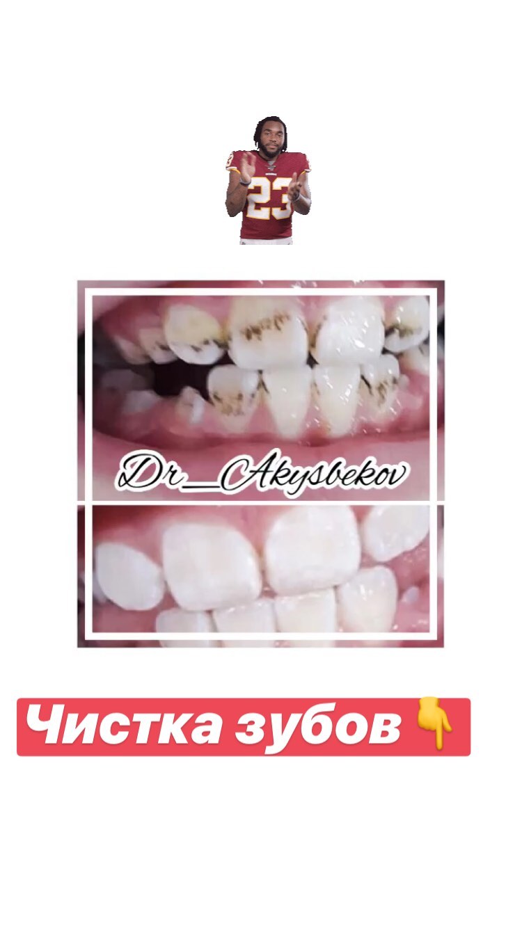 Реставрация зубов