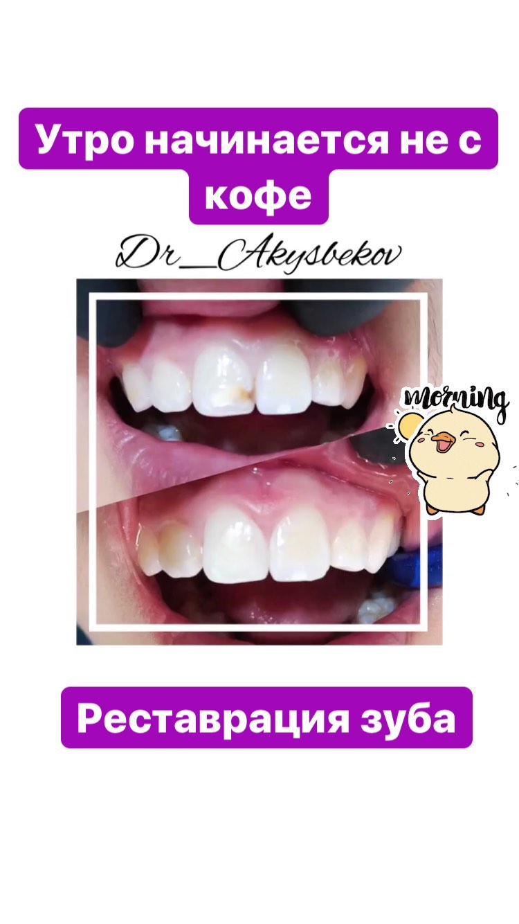 Реставрация зубов