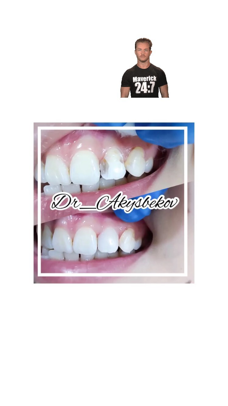 Пломбирование