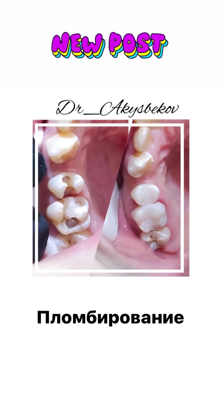 Пломбирование