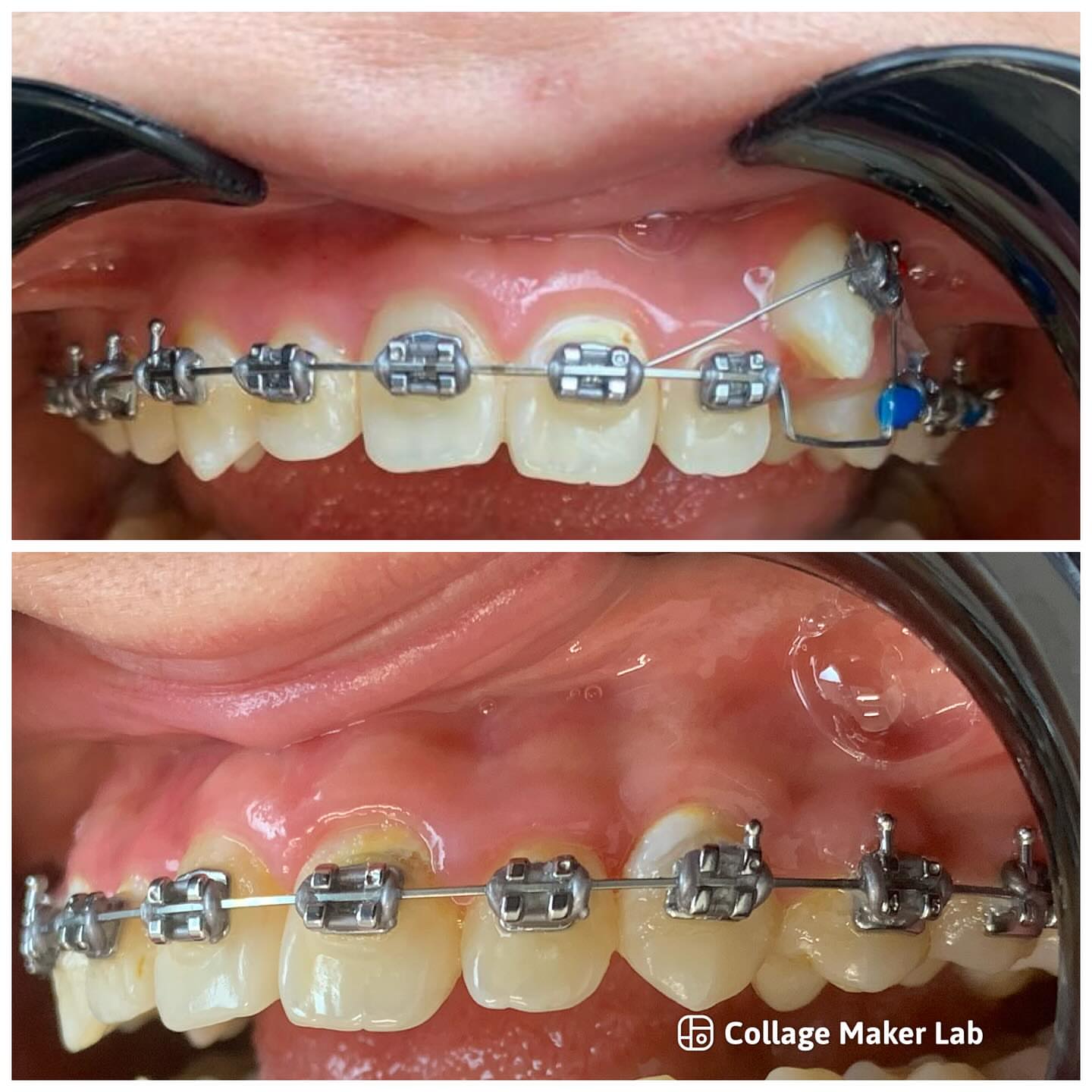 Лечение дистопии клыка