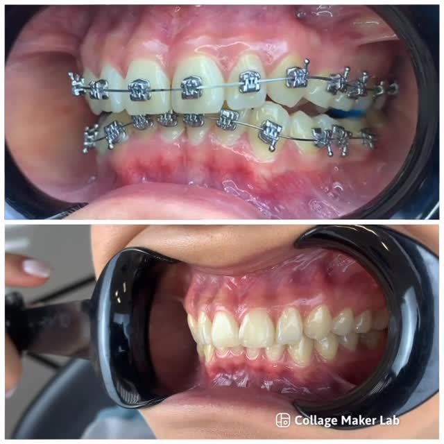 Глубокий прикус