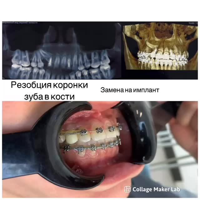 Лечение дистопии клыка