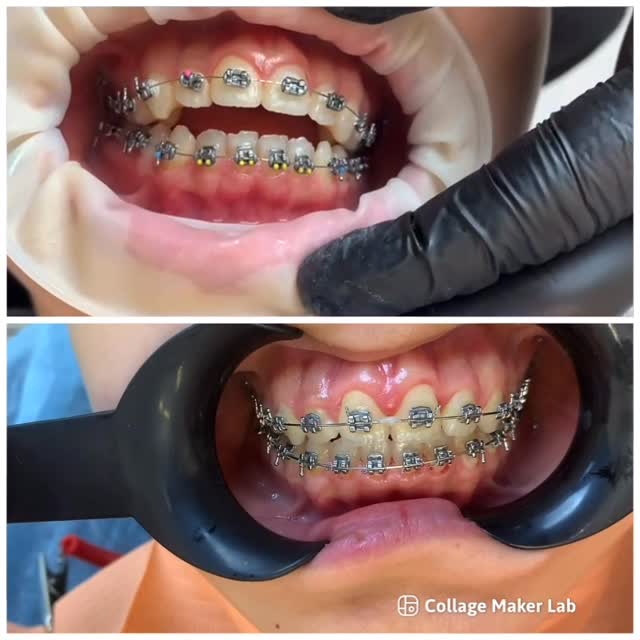 Открытый прикус