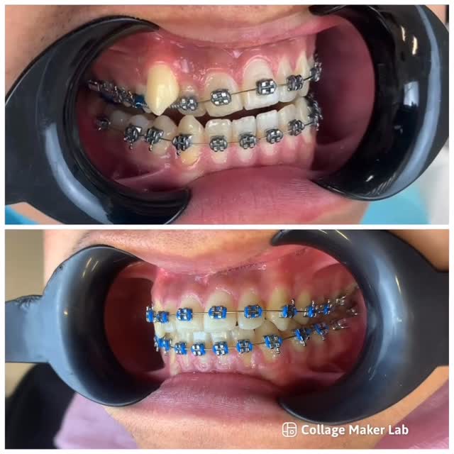 Установка брекетов