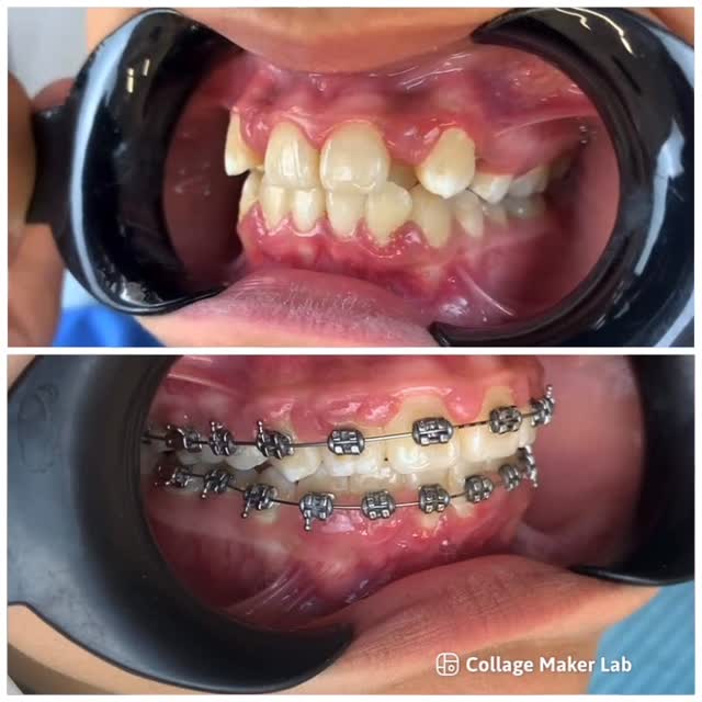 Установка брекетов