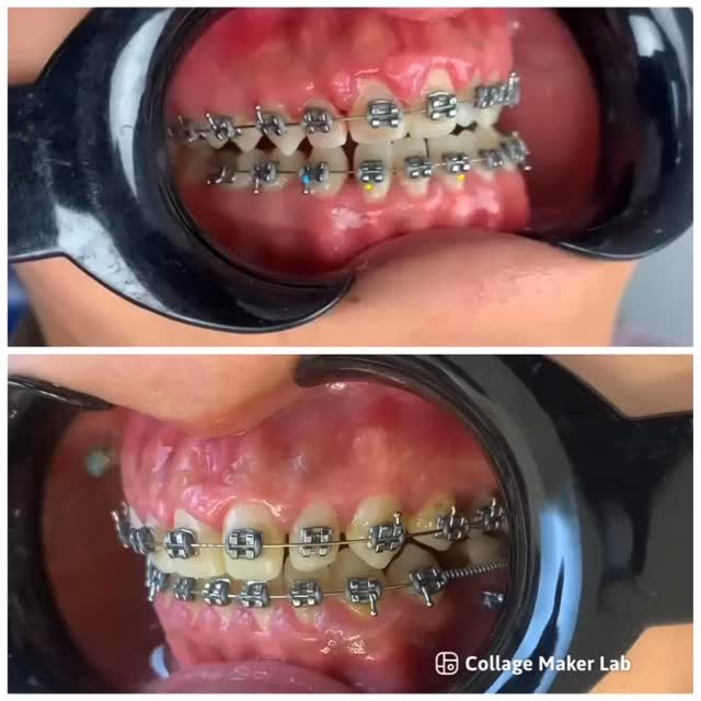 Результат ортодонтического лечения